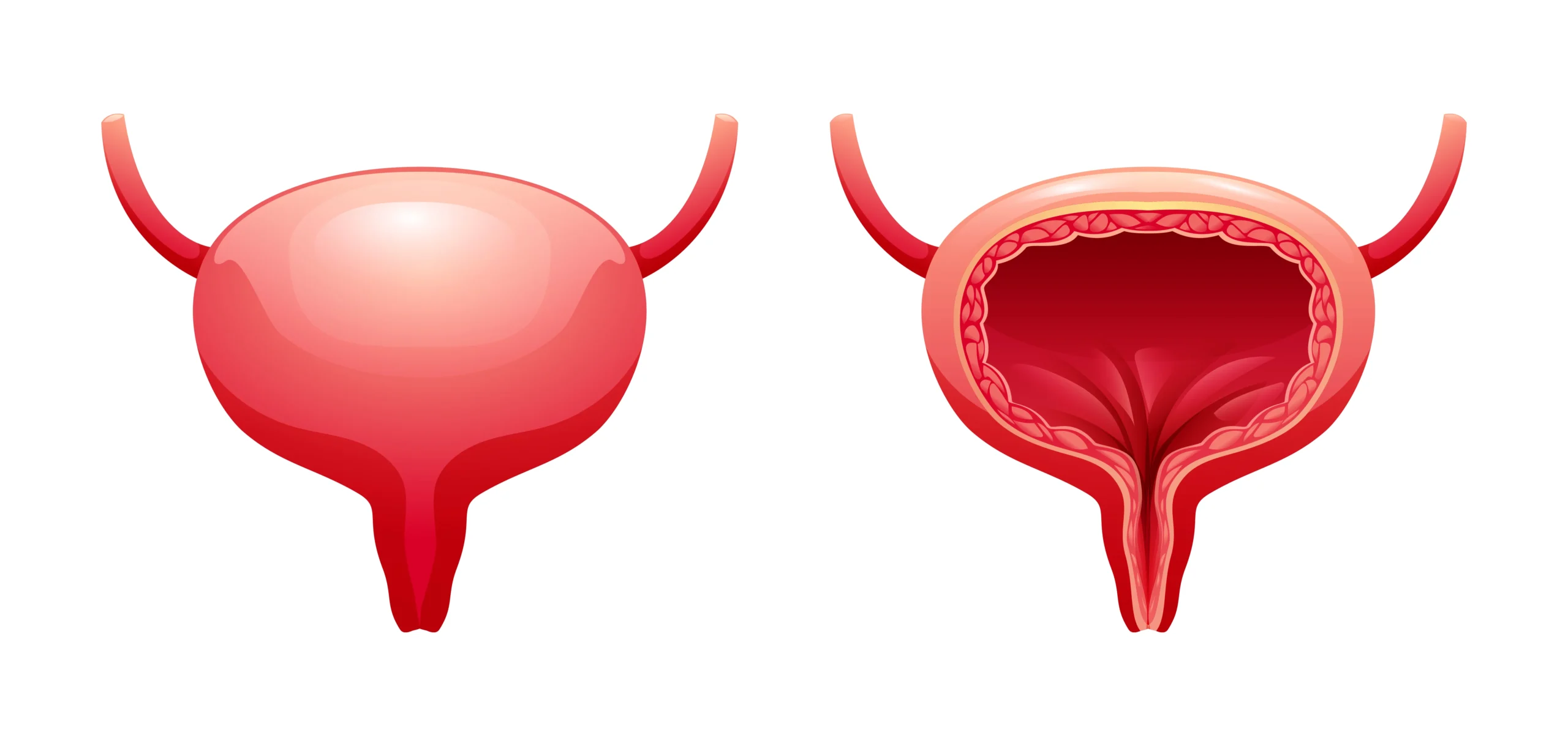 Bladder Neck Obstruction